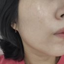 아셀 - 안양시 동안구 평촌대로374번길 9-7 | 한티역피부과 추천 - 스킨부스터 쥬브아셀 시술 후기
