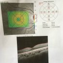 [질문]오른쪽 동공이 완전히 확대(Fully dialated pupil)되어 안경으로 보호해야하는데 도와주세요 이미지