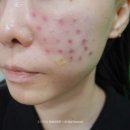 강남 피부과 줄기세포 피부주사 후기 ♪ 자가혈 스킨부스터, 다운타임 꿀팁