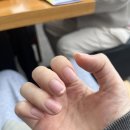 예손네일 | 사구체종양에 관하여
