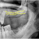 우리정내과의원 | 양평군치과 임플란트 기간은