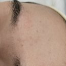 중고개 | 블랙헤드부터 화이트헤드까지, 용암동 여드름관리 꼼꼼에스테틱