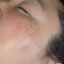 빛나달 | [공지] 기미패치 라보타치 추천 50대 한 달 사용 후기