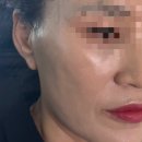 지지재 | 대전피부과 리쥬란힐러와 비슷하게 효과 좋은 필로드 후기 : 통증, 전후비교