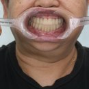 대한치과기공소 | 상당구 치과, 만성 치주염으로 인한 전악 임플란트 사례