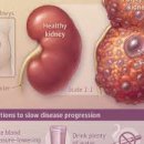 상염색체 우성 다낭성 신종[autosomal dominant polycystic kidney disease, ADPKD] 이미지