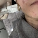 송파나루역4번출구 | 송파나루역 석촌역 피부과 미라젯 쥬베룩 스킨부스터 통증 3CC 효과 (+3일차 후기)