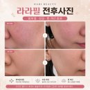 라라샵덕계점 | 양주 덕계 라라필 후기 |전후사진으로 확인하는 피부결 개선 효과, 나리뷰티