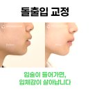 아름다운치과의원 | 돌출입 교정으로 입툭튀 탈출, 한예종 석관동 인근 교정 치료 후기