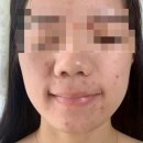 아이소이 잡티세럼 내돈내산 후기 색소침착 홈케어 관리 추천