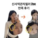 아침햇살약국 | 신사역피부과 내돈내산 신사관자필러 2cc 만족한 후기 다운타임 붓기 멍 등