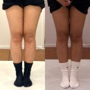 인천제일의원 | 인천지방분해주사 효과좋은 곳 찐추천｜인천 구월동 H의원 솔직 후기