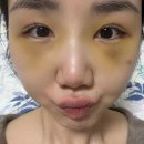 멍꿀잠 | 내시경 이마거상후기 (4-10일차) 실밥제거 / 노란멍과의싸움