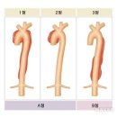 도끼로 찍는 아픔 '흉부 대동맥 질환' 이미지