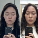 에이블러의원 | 김해 에이블러의원 쿨소닉 쿨페이즈 리프팅 효과 통증 후기