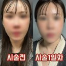 온다(onda) | 내돈내산) 리프팅 시술 뭐할지 고민이라면?시술별 효과 + 심부볼 개선 온다(ONDA) 리프팅 찐 후기👍