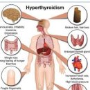 갑상선 기능 알고 갑성선기능 항진증 원인 정리 이미지