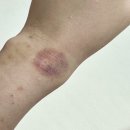 역곡휘문한의원 | 육아 손목 심한 통증 역곡휘문한의원에서 치료중 3번 방문한 내돈 후기