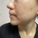 [일상] 압구정 미랩의원 강남얼굴리프팅 히든브이주사 2차 리뷰