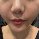 제로피부과의원 | 성수동피부과 밴스의원 성수 온다리프팅 추천 후기