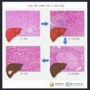 갱신형 급성간염(A,B,C형)진단비보장 특별약관 (급성간염(A,B,C형)의 정의 및 진단확정) 이미지