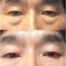 시원성형외과의원 | 광주 서구 치평동 상무역 성형외과 이루다의원 눈성형후기 중요성