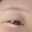 세안@ | 한관종 재발 아그네스 시술 제거 후기 세안, 재생크림 등 많은 정보 공유