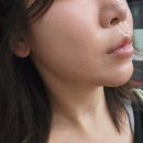 삼성유지 | 삼성역피부과 온다리프팅 7만줄 가격, 유지기간, 통증, 효과 솔직 후기