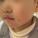 내돈내산) 35개월 아기 흉터 개선 관리 / 안산 브리즈 성형외과 1~5회차 시술 후기