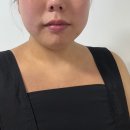 승모근패치]요즘 핫한 홈케어템✨ ‘에셀라이트 한가인 승모 패치 플러스’ 솔직 후기 (예신, 직장인 강추!)