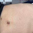 고령백의원 | 인천 담낭수술 | 배액관까지 필요했던 심한 담낭염 단일공 복강경 치료사례