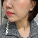 박차돈 | 인천논현피부과 웨딩관리 스킨부스터 에버클 수부지 효과 후기