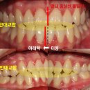 보우치과의원 | 양악수술 고통 없었던 안면비대칭 교정 후기 (고등학생)