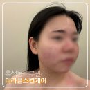 티스토어마켓 | 흑석동 피부관리 미라클 스킨케어 엑소필 받고 온 후기