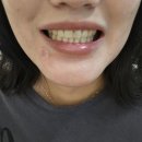 거미 | 거미스마일 교정 끝!! 치아교정가격 후기 총정리