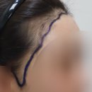 송천자이치과의원 | 강남 밴스모자이너의원 20대 여자헤어라인모발이식ㅣ원장 1:1 디자인 상담 및 예약 꿀팁