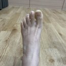 효동한의원 | 발목 견열골절 1주차의 기록