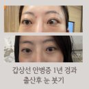 일동제약(주) | (6) 갑상선 안병증 1년후기, 출산 후 눈이 부어요, 사트랄리주맙 임상 결과