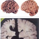 ** 혈관성 치매 ** 이미지