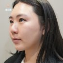 울산남구 달동 피부과 의원 추천,페이스 온다리프팅 효과 후기