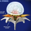 SPINAL STENOSIS 이미지