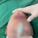 오늘성형외과의원 | 턱끝만 줄이면 갸름해질까요?신사역 오늘성형외과 투컷수술 후기