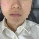 수피부과  의원 | [내돈내산] 공장형 피부과 엑셀브이레이저 솔직후기 / 밴스의원 피부과 내돈내산 후기