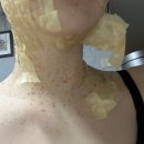 흰민들레만두 | 편평사마귀 3대 성지 합정역 편사 제거 후기 2탄(다음날~5일차 듀오덤 교체 후기,듀오덤 알러지,제거...