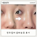 쁘띠멍 | 전주필러 잘하는 곳 이마필러, 코필러 후기