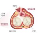 대동맥판막 협착증 관리 이미지