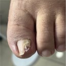 매료 | 서면내성발톱 발톱무좀 복합적 관리 후기 매료네일in뷰티