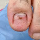 북면166 | 발톱 멍 빼는 법? 가평 멍든 발톱 관리 후기