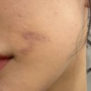 괜찮아요한의원 | 대구여드름한의원 새살침 2회차 후기