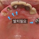 트리플치과의원 | 임플란트수면마취로 통증과 치과공포증 극복하고 성공적으로 식립 케이스 철산역 임플란트